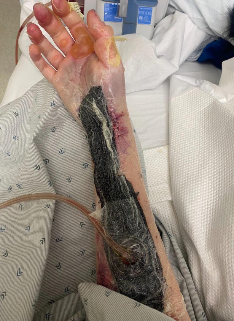 An arm being intubated and covered with blood and bruising. The hand is extremely swollen. 