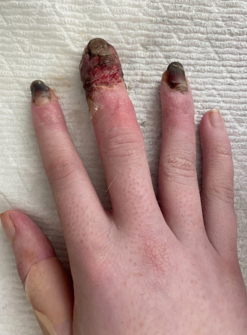 A photo of the author's fingers completely swollen and and bloodied. 